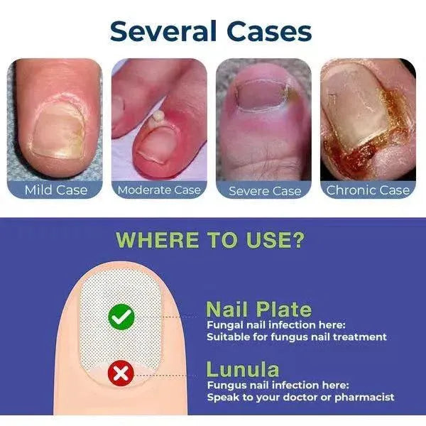 Anti-Paronychia Relief Oil  (BUY 1 GET 1 FREE)