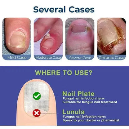 Anti-Paronychia Relief Oil  (BUY 1 GET 1 FREE)