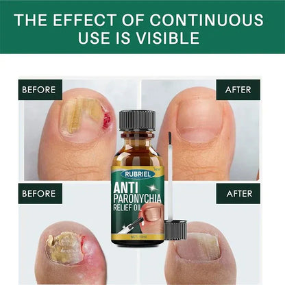 Anti-Paronychia Relief Oil  (BUY 1 GET 1 FREE)